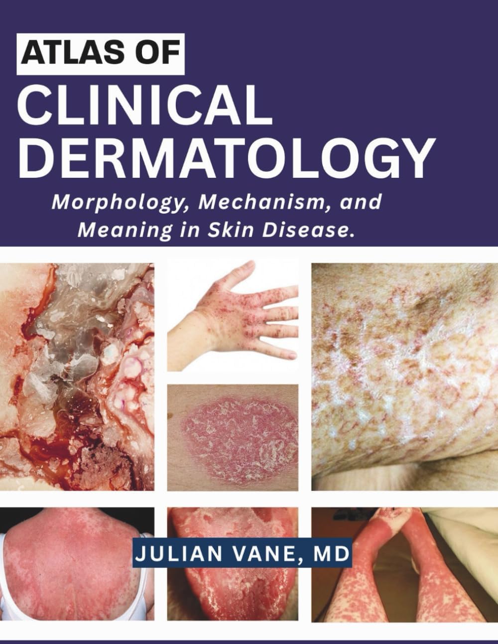 ATLAS OF CLINICAL DERMATOLOGY: Morphology, Mechanism, and Meaning in Skin Disease. by MD, JULIAN VANE,